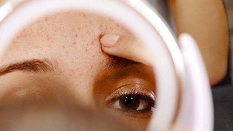 Unlock Clear Skin The Shocking Blackhead Secret Revealed